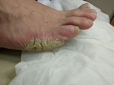 Педикюр медицинский. Подолог